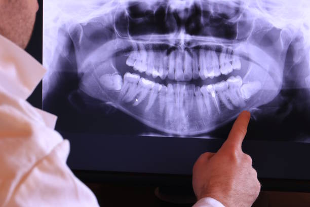 Best Emergency Wisdom Teeth Removal in Butler Beach, FL